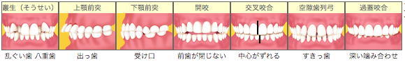 不正咬合